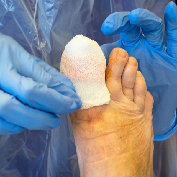 Ingrown toenail surgery Sunshine Coast