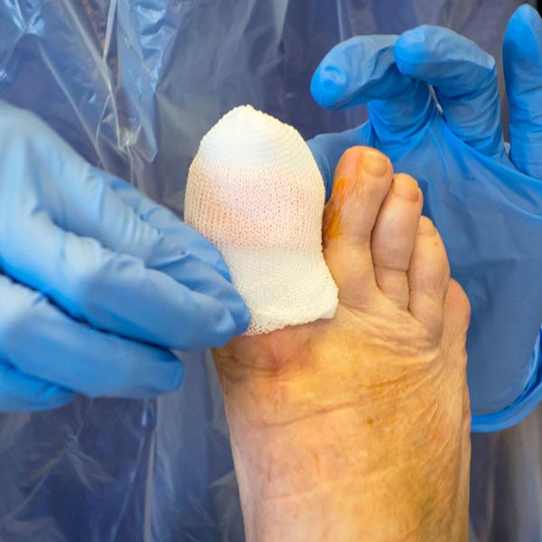 Nail Surgery | Coastal Podiatry Sunshine Coast